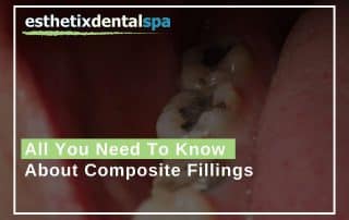 All You Need To Know About Composite Fillings