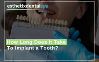 How Long Does It Take To Implant a Tooth