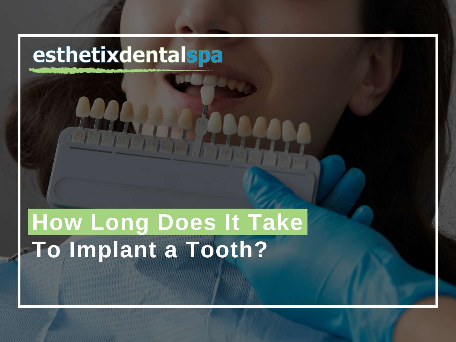 How Long Does It Take To Implant a Tooth