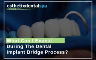 What Can I Expect During The Dental Implant Bridge Process