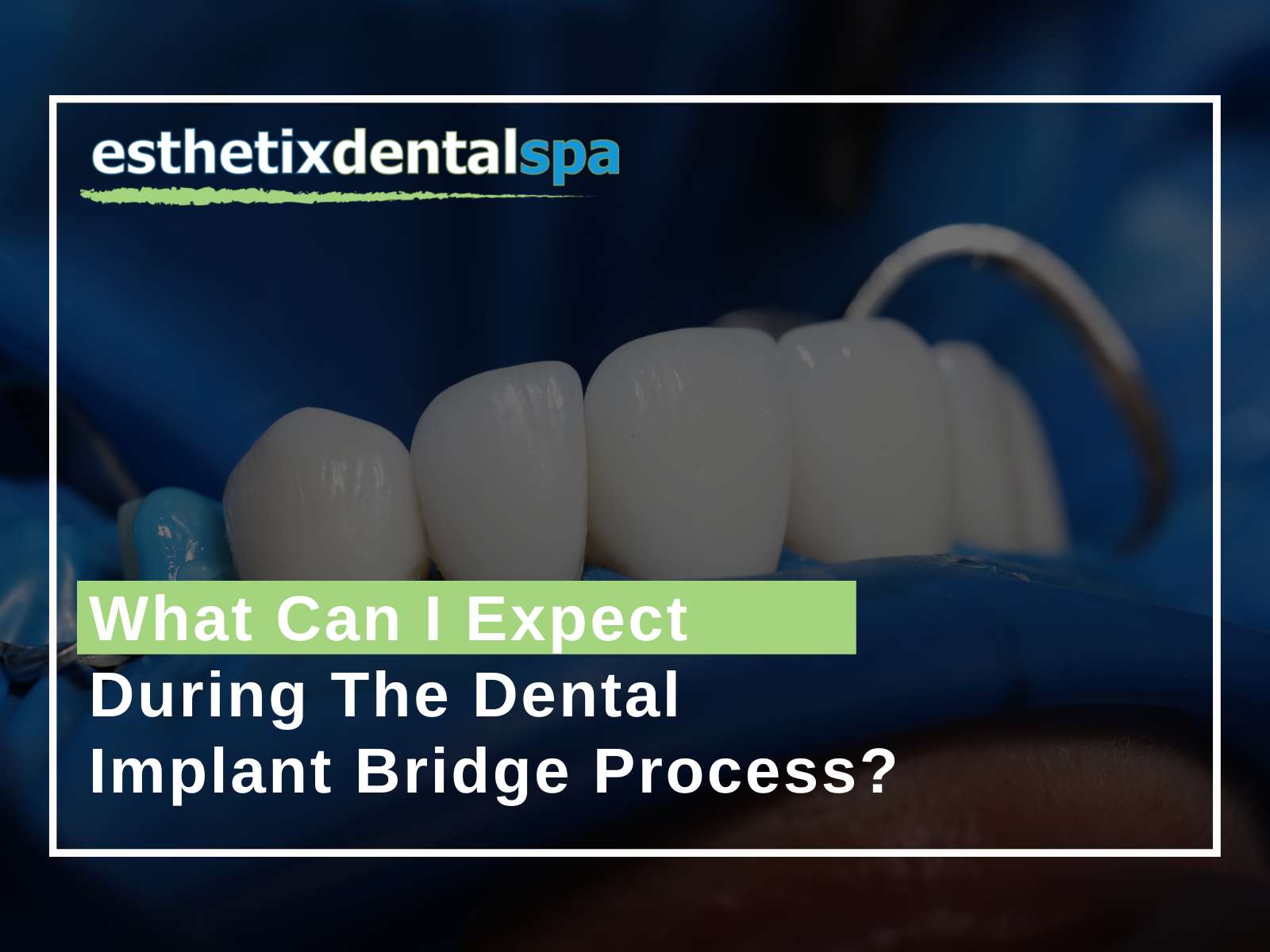 What Can I Expect During The Dental Implant Bridge Process