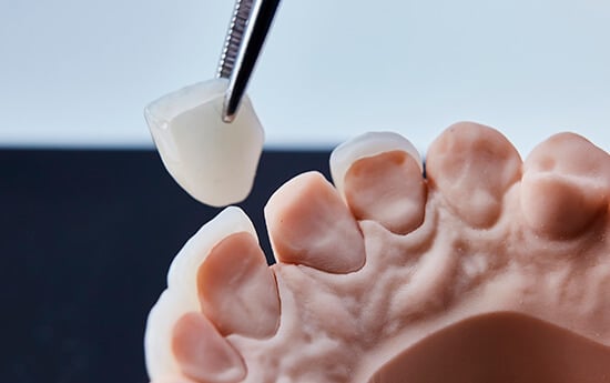 Bonding Ceramic Veneers On Dental Mold