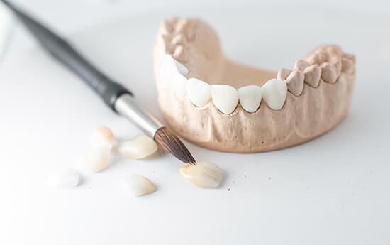 Porcelain Veneers On Dental Mold