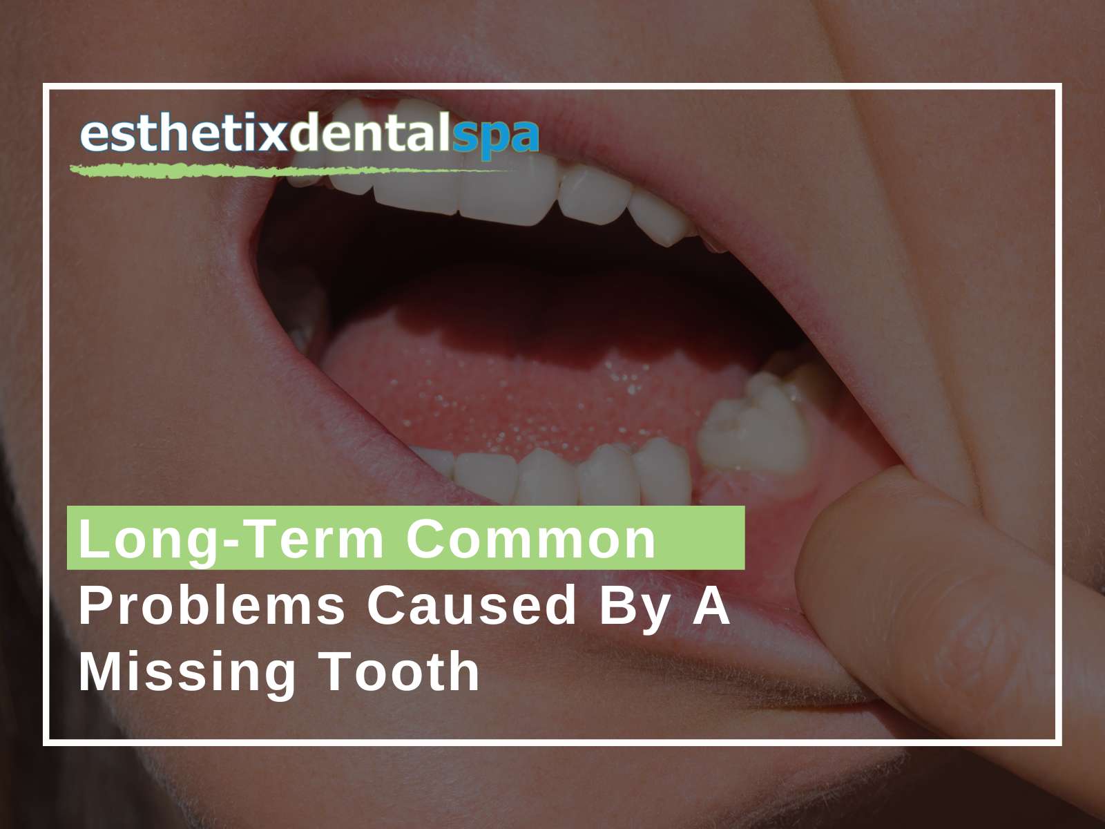 Long-Term Common Problems Caused By A Missing Tooth