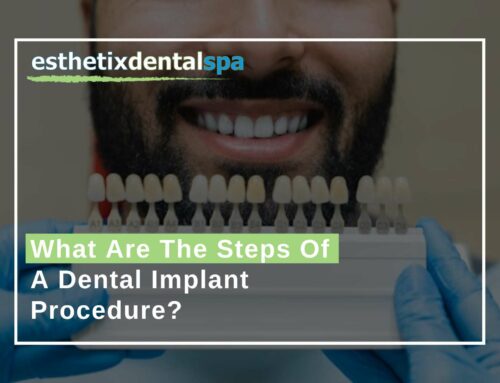 What Are The Steps Of A Dental Implant Procedure?