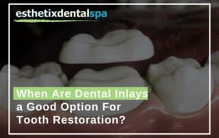 When Are Dental Inlays a Good Option For Tooth Restoration