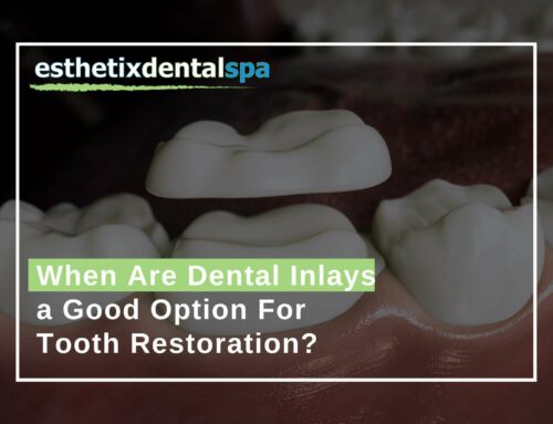 When Are Dental Inlays a Good Option For Tooth Restoration?