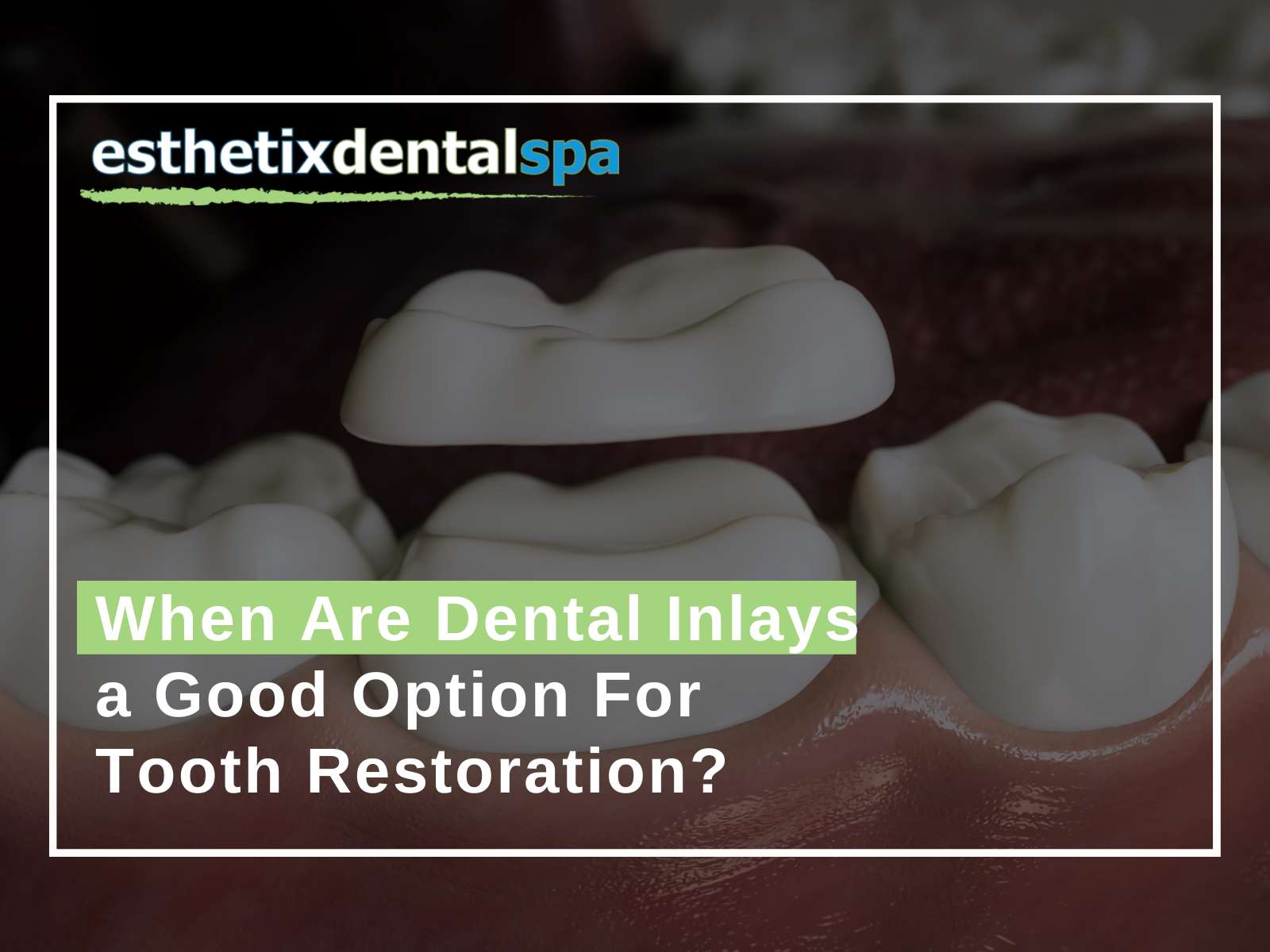 When Are Dental Inlays a Good Option For Tooth Restoration