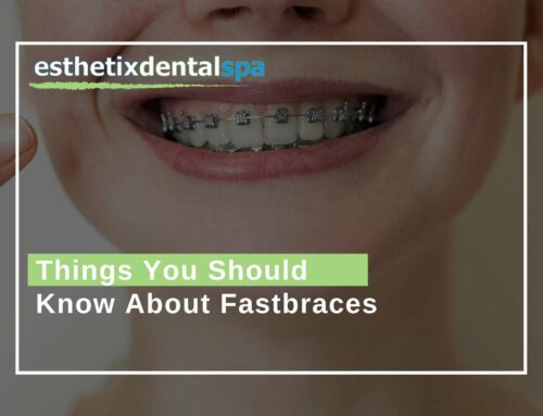 Things You Should Know About Fastbraces