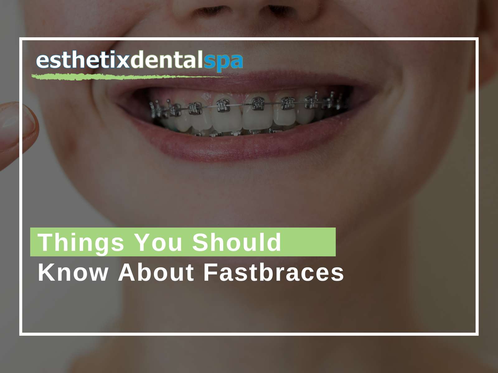 Things You Should Know About Fastbraces AZ