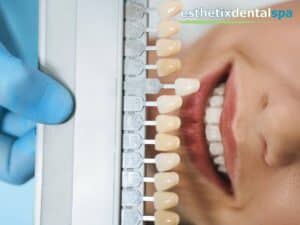 Shade comparison chart used during professional Teeth Whitening