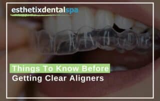 Things To Know Before Getting Clear Aligners