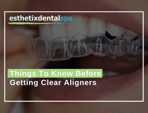 Things To Know Before Getting Clear Aligners