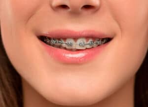 Braces Can Improve Your Smile, Health, And Confidence