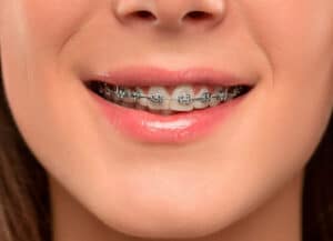 Positive Aspects Of Wearing Braces