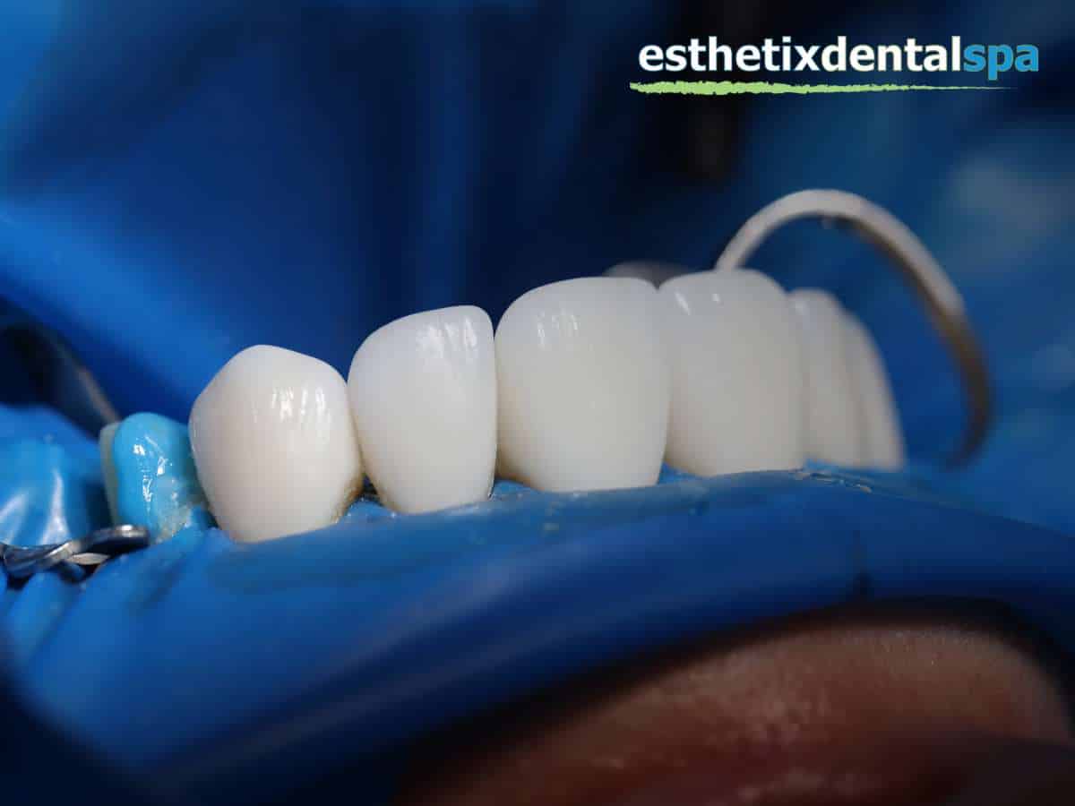 Porcelain Crowns