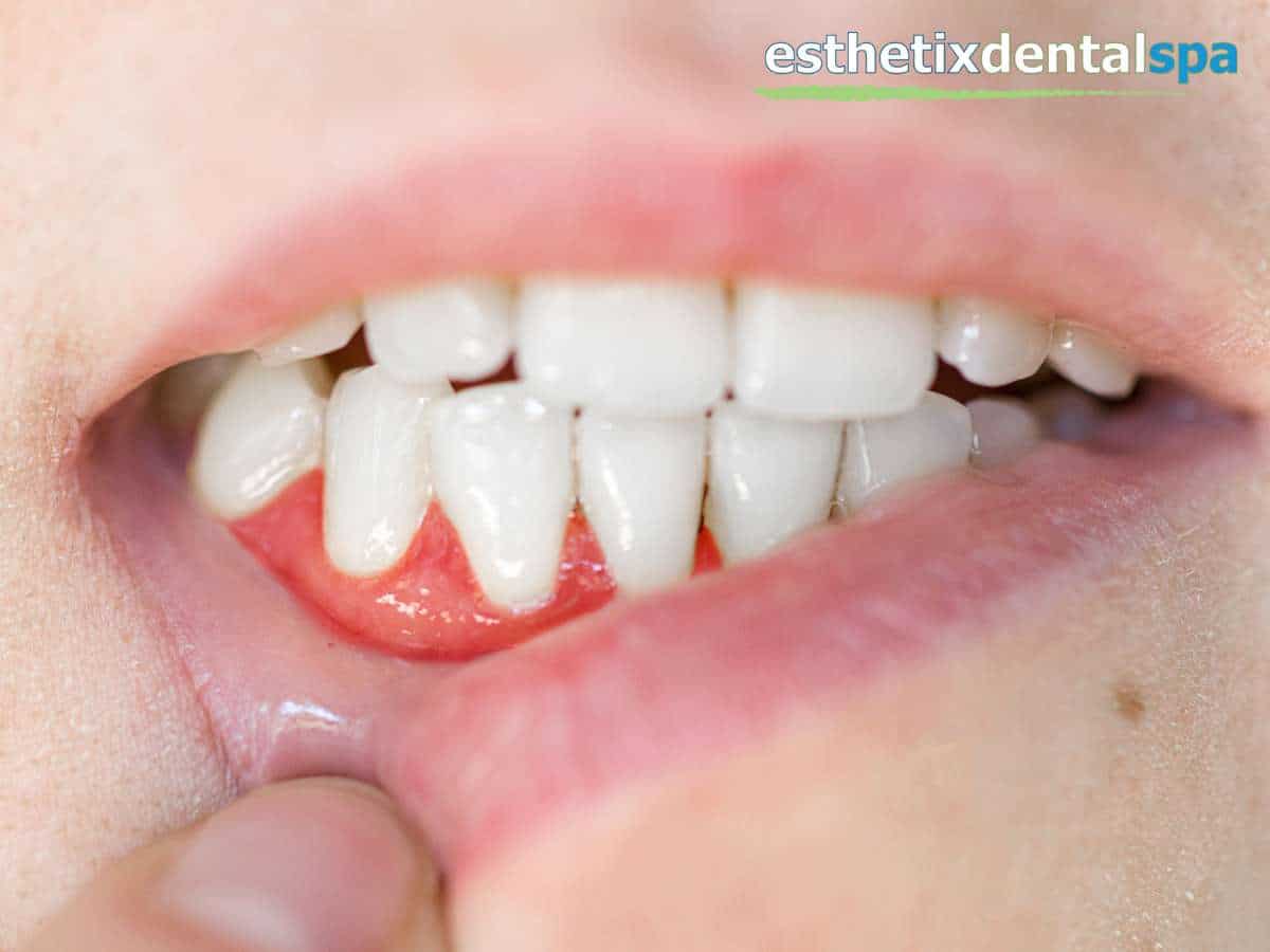 Close-up of a mouth with signs of gum disease, showing swollen gums and irregular teeth alignment