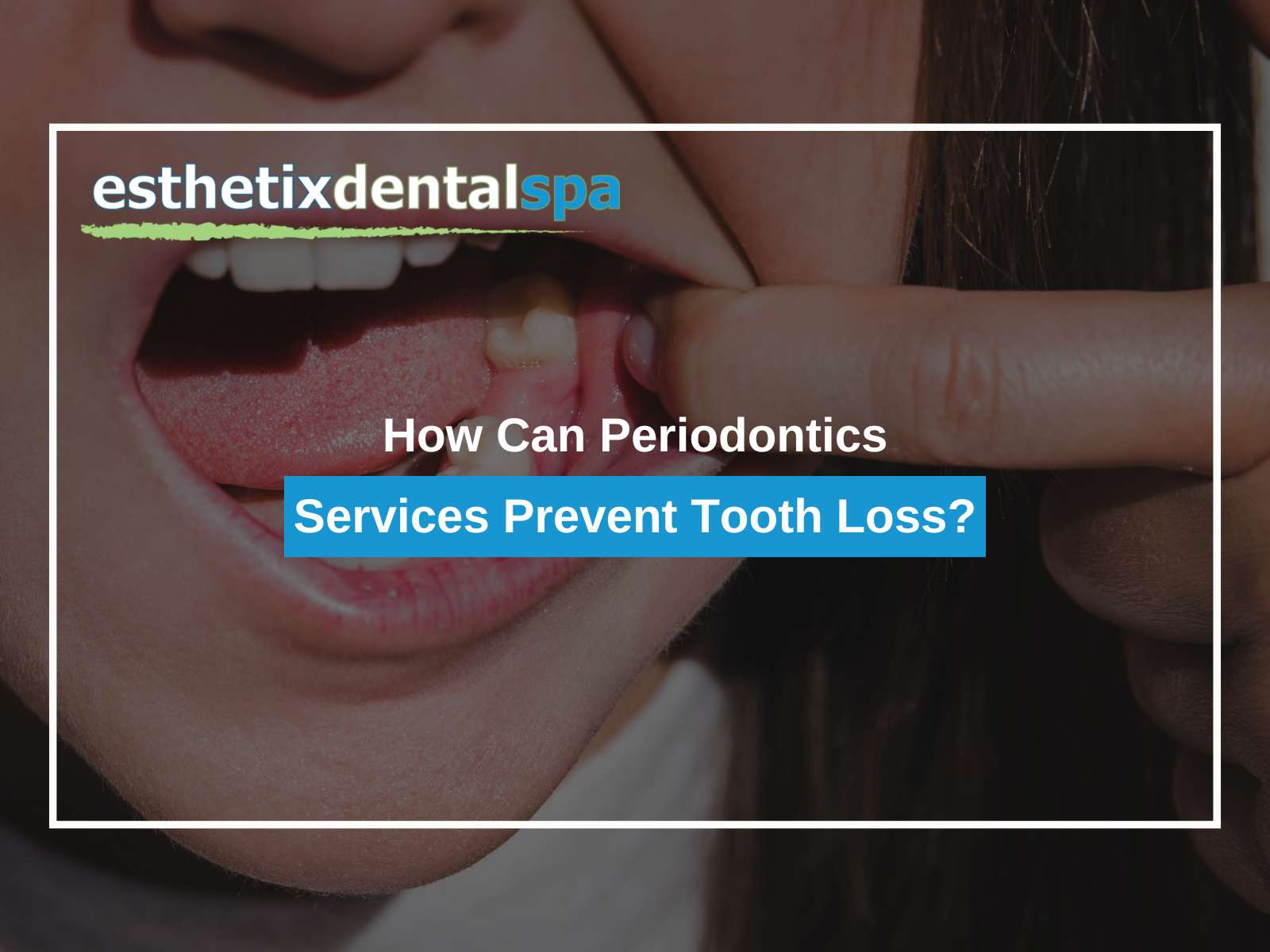 How Can Periodontics Services Prevent Tooth Loss