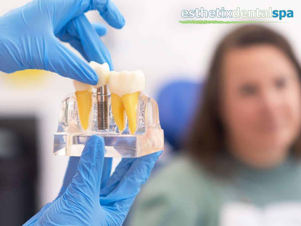 Dental Implants Consultation at Esthetix Dental Spa